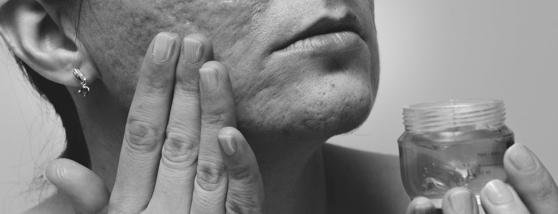 How to Use Aloe Vera for Acne