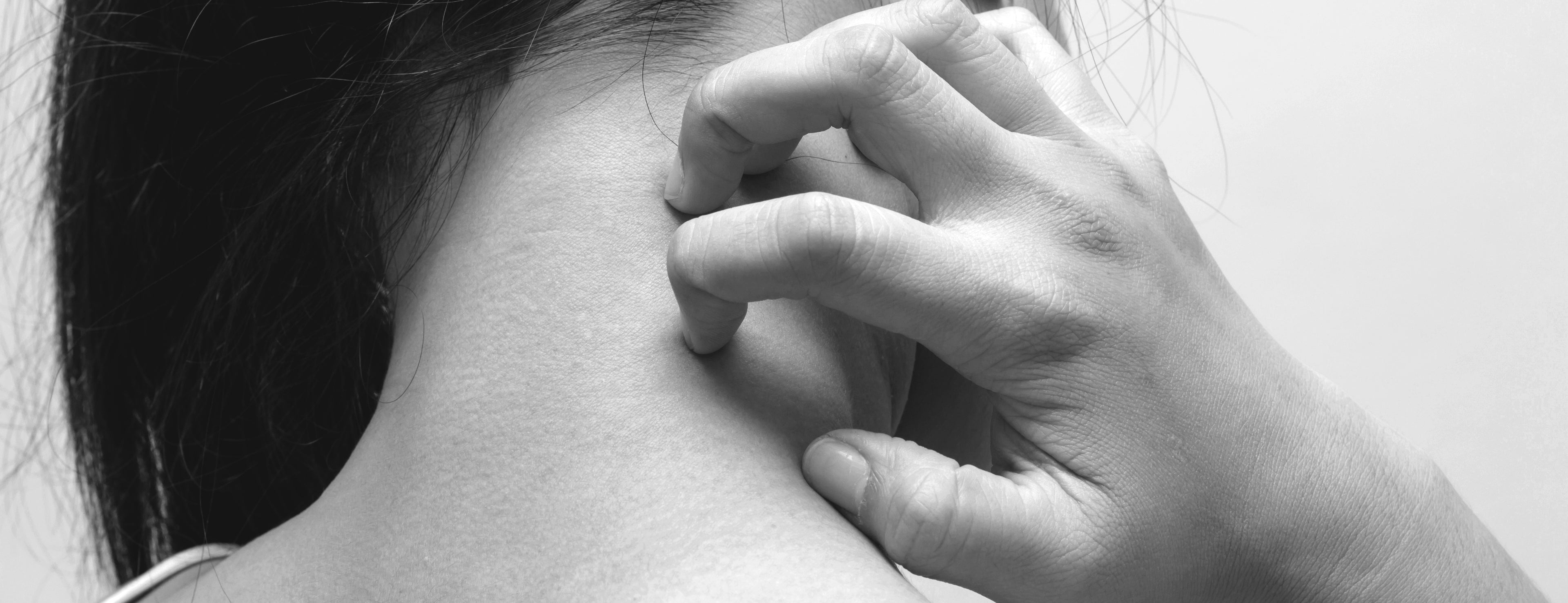 Eczema Remedies for Winter Skin
